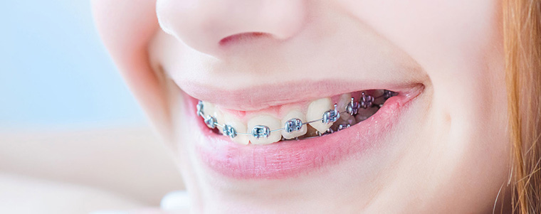 dental braces