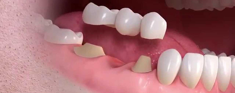 dental crowns and bridges