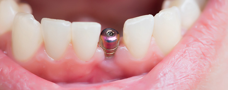 dental implants