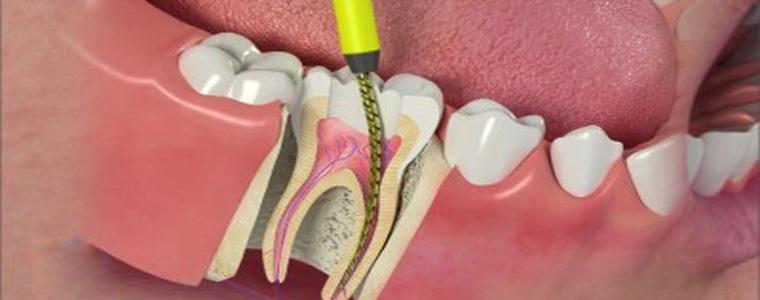 root canal treatment