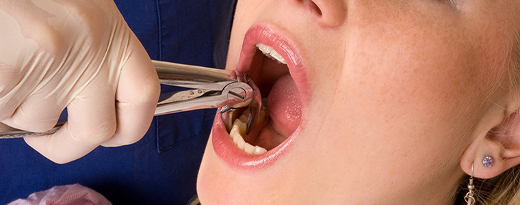 tooth extraction